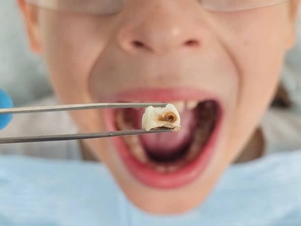 Best Emergency Gum Treatment in Placentia, CA